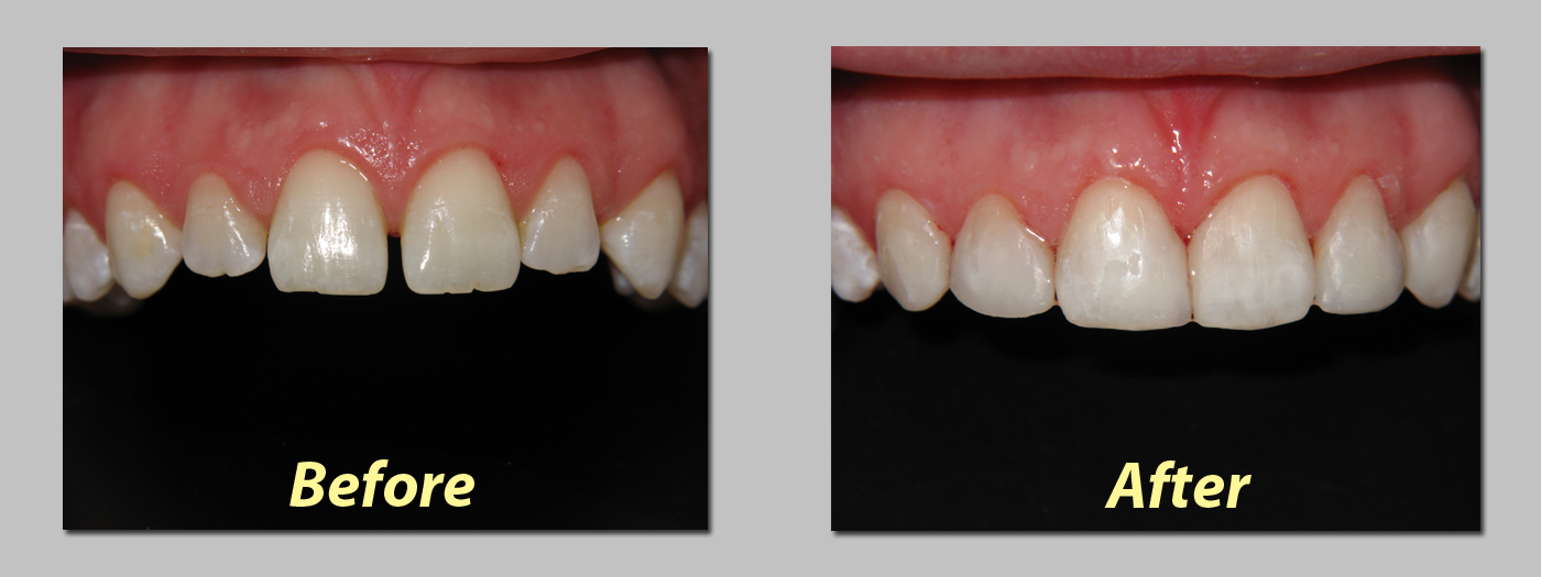 Minimally Invasive Cosmetic Filling (Light cure filling)