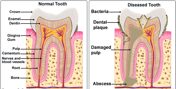 Root canal treatment (preserved tooth)